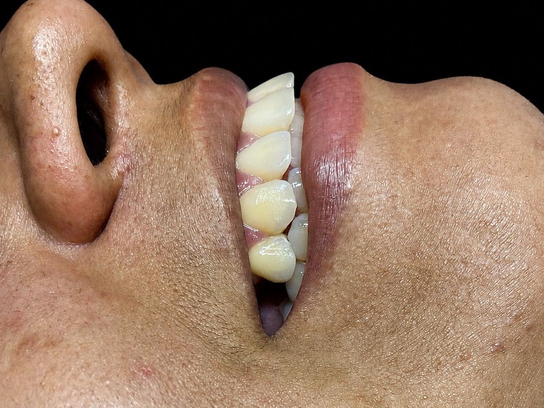 Antes do implante dentário - caso de dente ausente