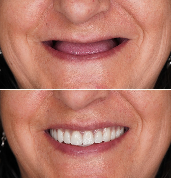Antes e depois de prótese com recuperação do sorriso