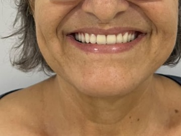 Resultado de protocolo sobre implantes com sorriso harmonioso